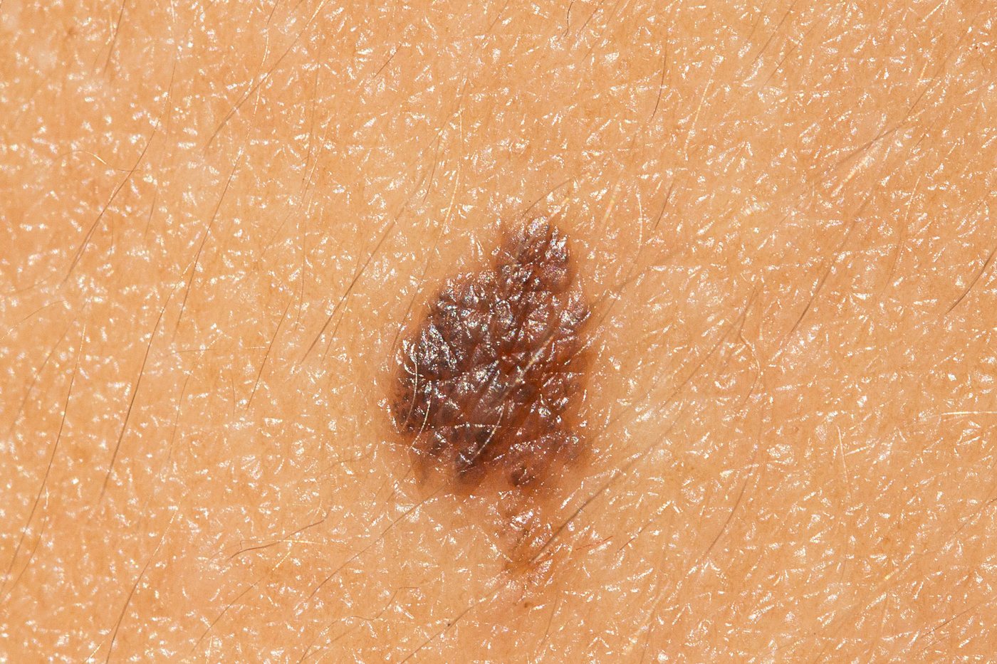 A raised, darkly pigmented mole on skin of the kind assessed at a skin biopsy appointment