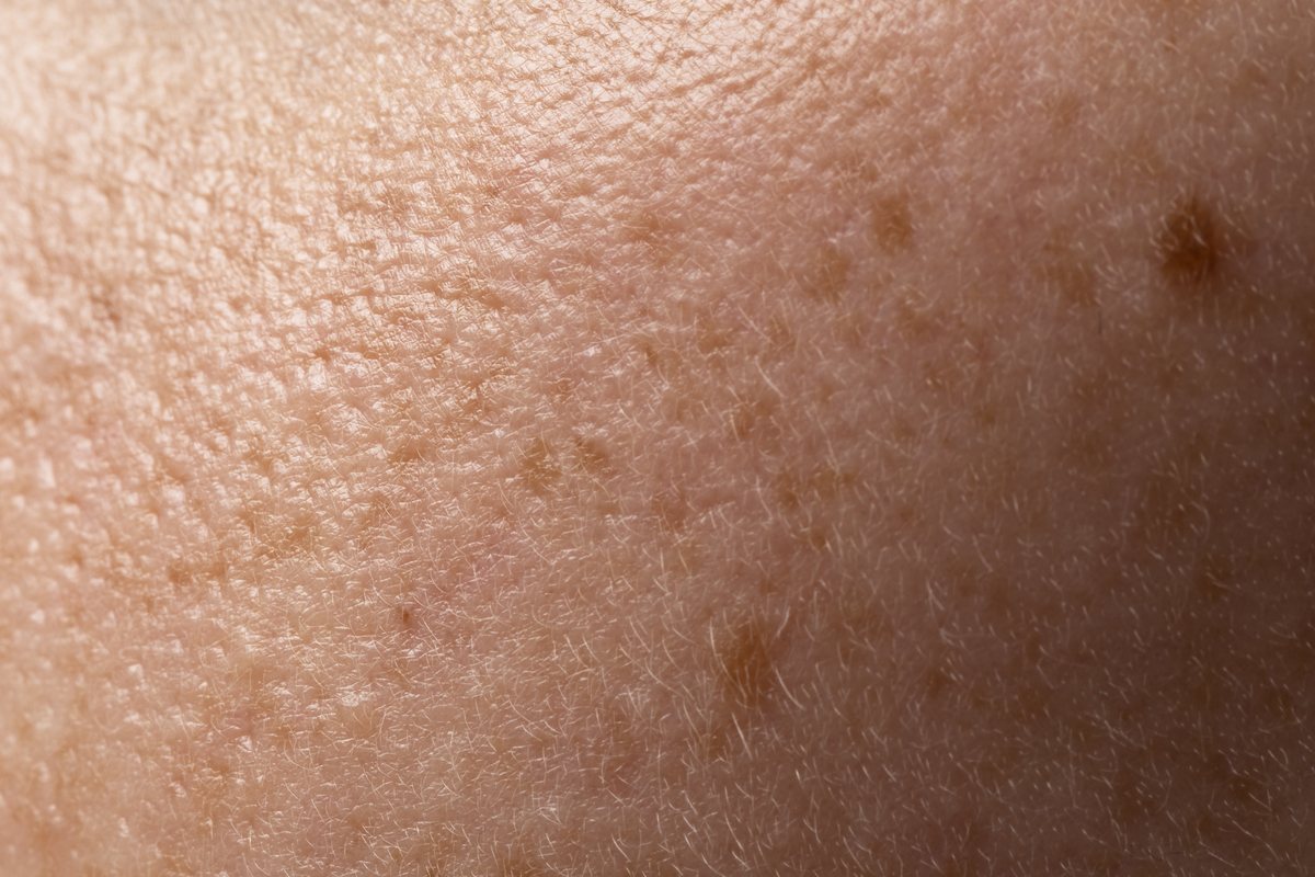 Skin cancer check: a close-up of freckled skin showing moles and sun spots