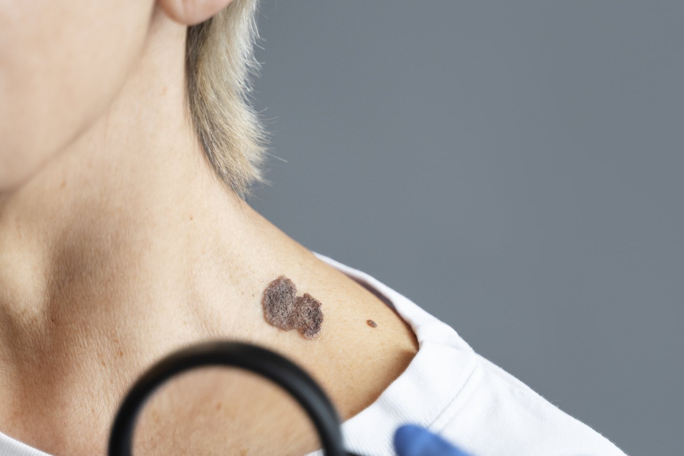 Skin cancer check: a clinician using a magnifier to examine a pigmented mole on a shoulder